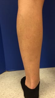 image of left leg after treatment