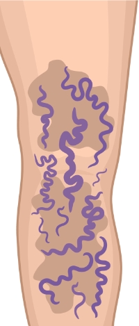 discoloration of skin with varicose veins graphic