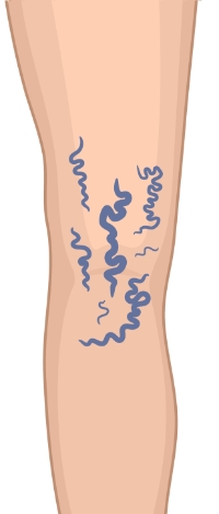 stage two varicose veins graphic
