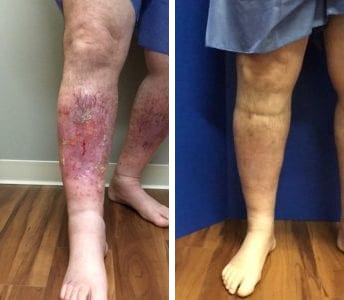 patient before and after ultrasound sclerotherapy treatment