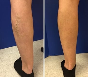 varicose veins with swelling