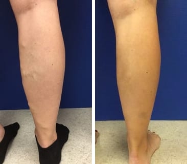 before & after treatment for varicose veins