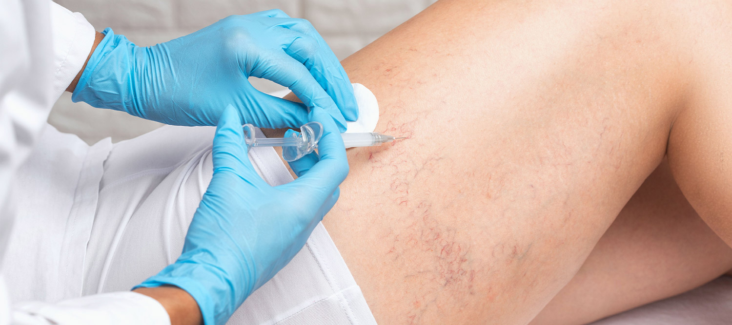Sclerotherapy treatment at Northern Michigan Vein Specialists