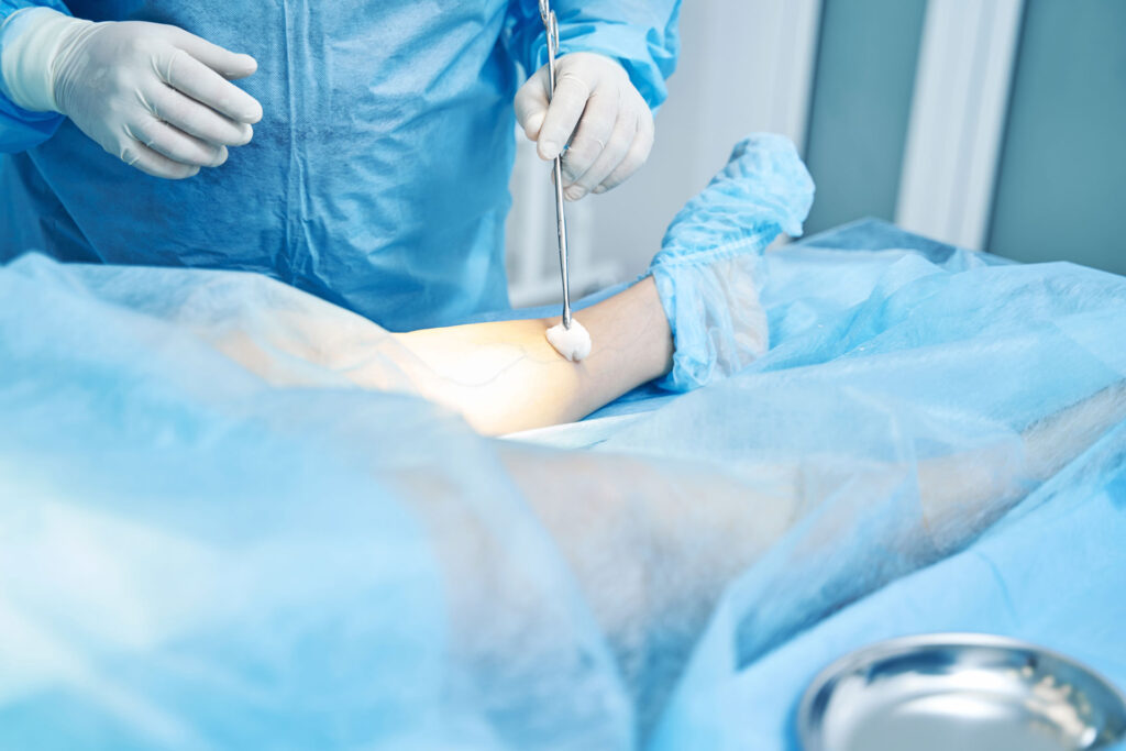 Ambulatory Phlebectomy | Northern Michigan Vein Specialists