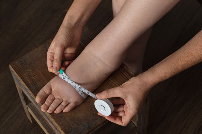 What-Is-Lymphedema-img