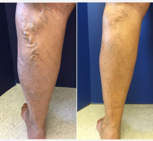 patient's leg with varicose veins and after treatment