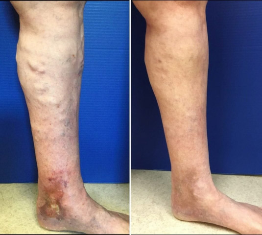 patient before varicose vein treatment and after