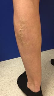 image of left leg before treatment