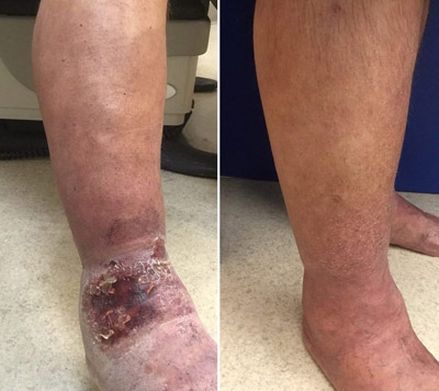 patient with venous ulcer on foot
