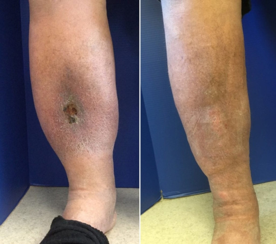 patient with venous ulcer before and after