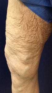 patient's inner leg after their vein treatment