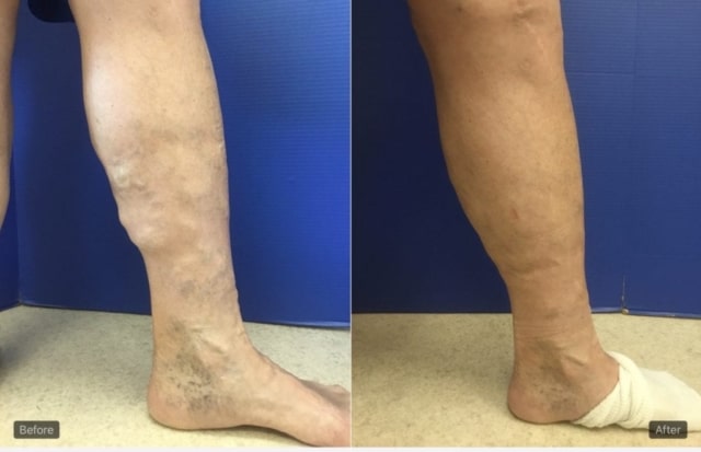 left leg before and after treatment of varicose veins with swelling