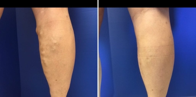 inner left knee and calf with varicose vein