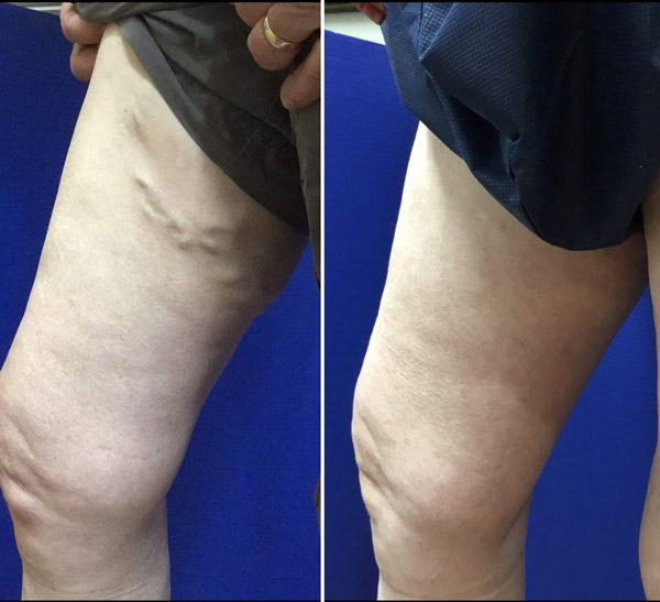 patient with varicose veins on upper inside thigh before and after