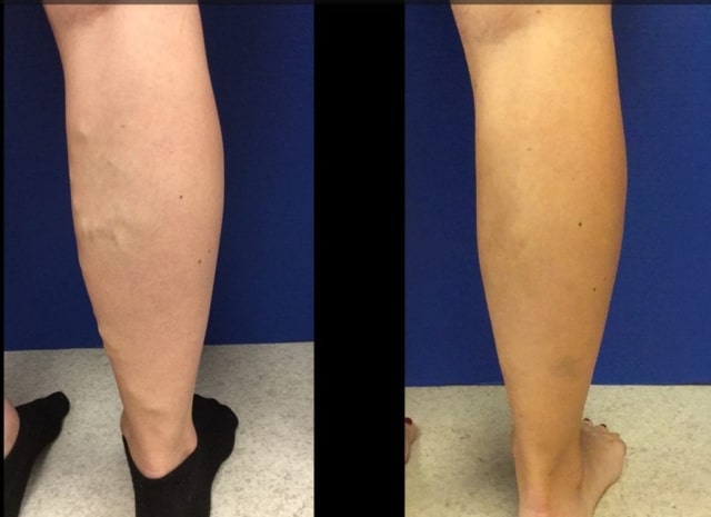 patient before and after vein treatment for back of right calf