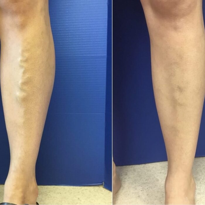 patient shin before and after varicose vein treatment