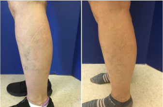 Before and After Leg Spider Patient