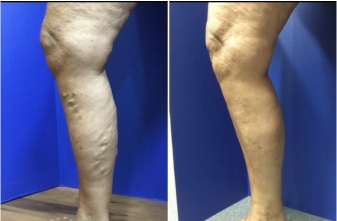 Before and After Leg Spider Patient
