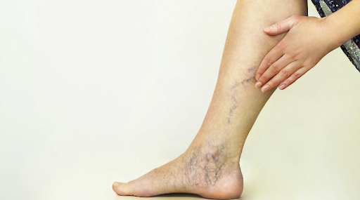 Why Ignoring Venous Disease Can Lead to Serious Complications