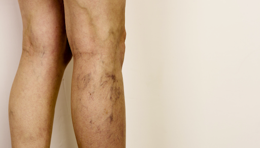 How Compression Therapy Can Help with Venous Insufficiency