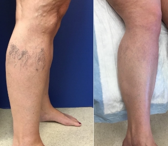 Leg-vein-treatment