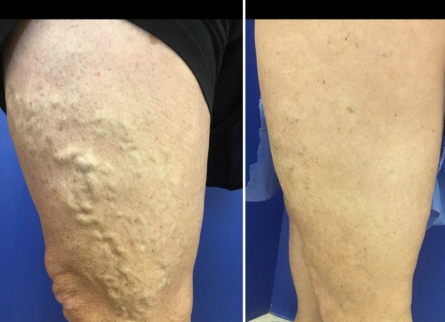thigh-with-varicose-veins-before-and-after