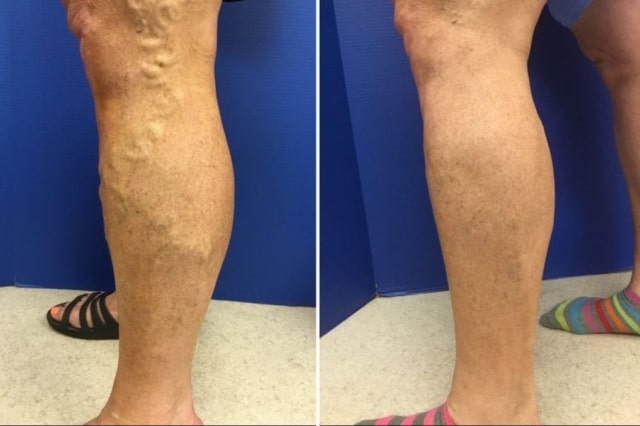 varicose-veins-around-knee-and-calf-before-after