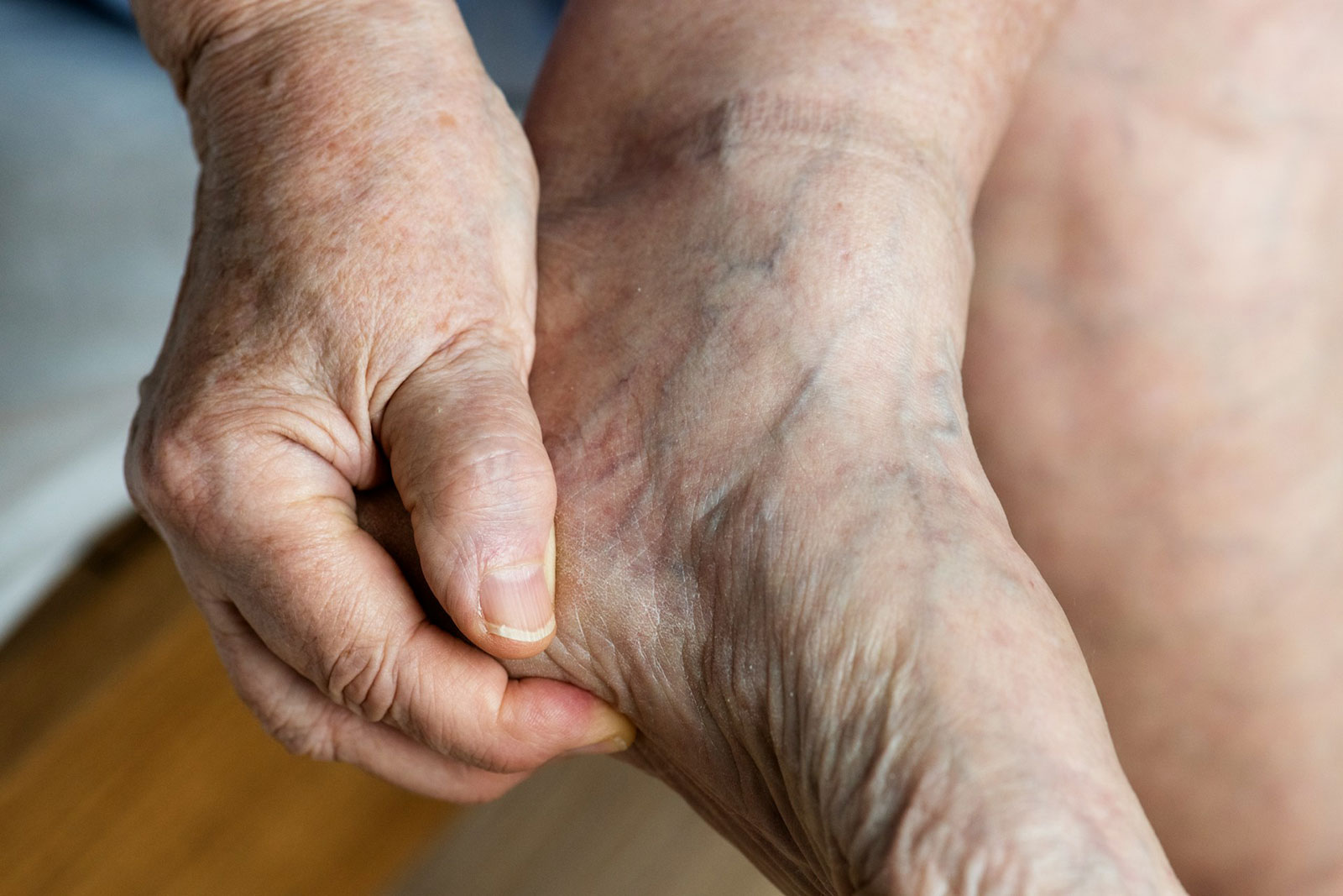 nm-vein-ankle-varicose-veins
