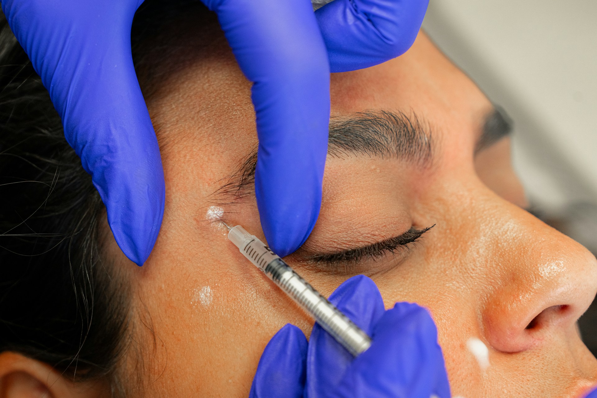 nm-vien-botox-treatment