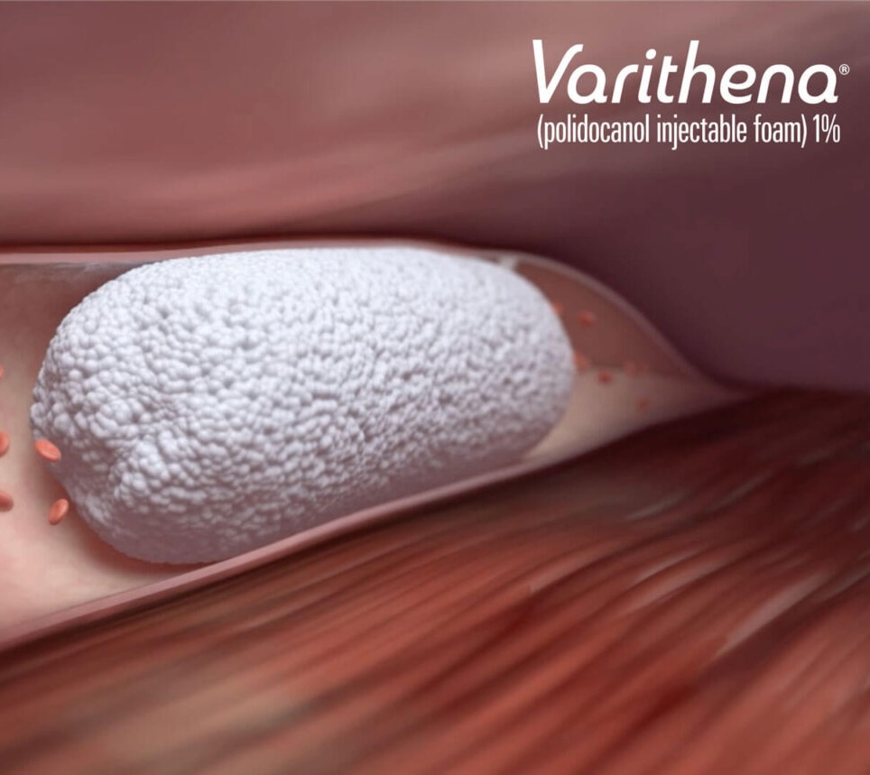 varithena-nm-vein